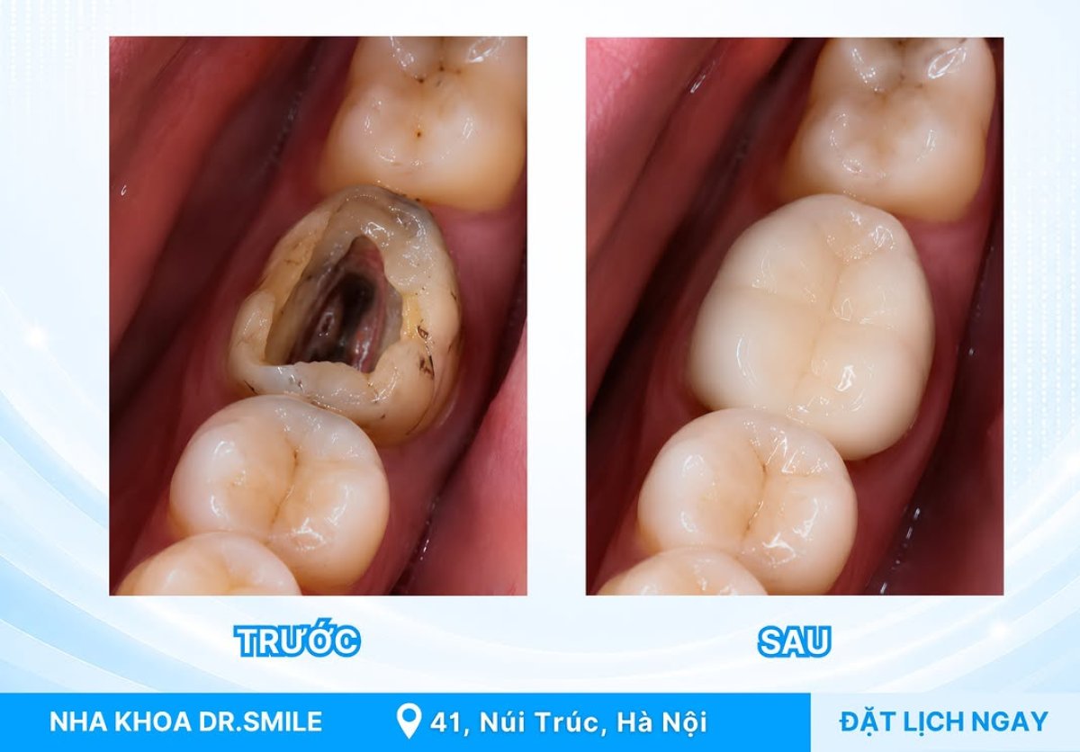 نتيجة قبل وبعد تركيب تاج الأسنان في عيادة Dr. Smile، ترميم الضرس