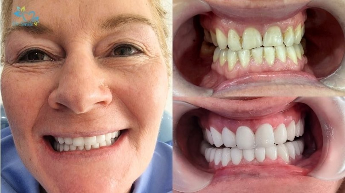 До та після встановлення вінірів у Dr. Smile Dental Clinic, природний результат посмішки
