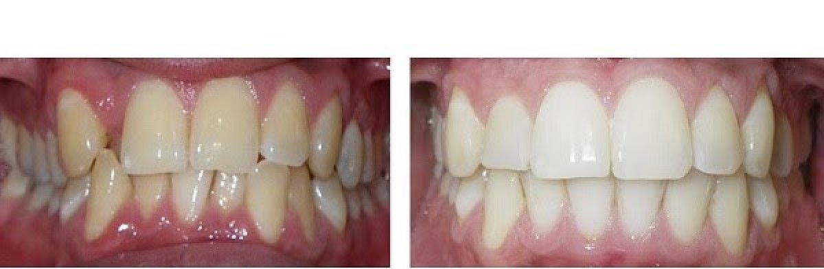 Before and after Invisalign results at Dr. Smile Dental Clinic – straighter, aligned teeth
