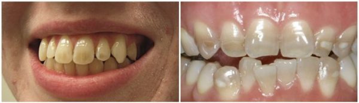 Before and after tooth whitening results at Dr. Smile Dental Clinic, visibly brighter teeth