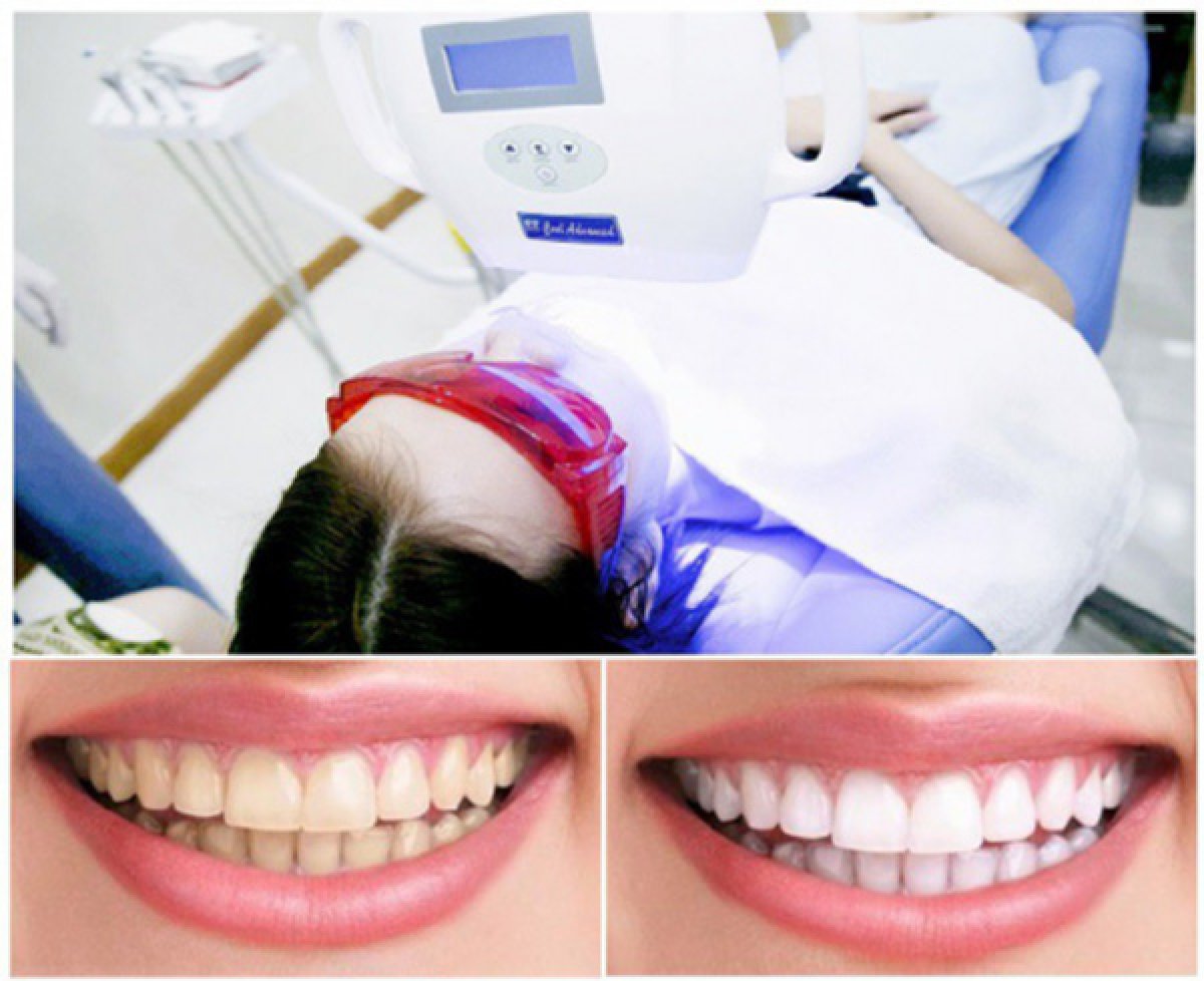 Before and after tooth whitening results at Dr. Smile Dental Clinic, visibly brighter smile