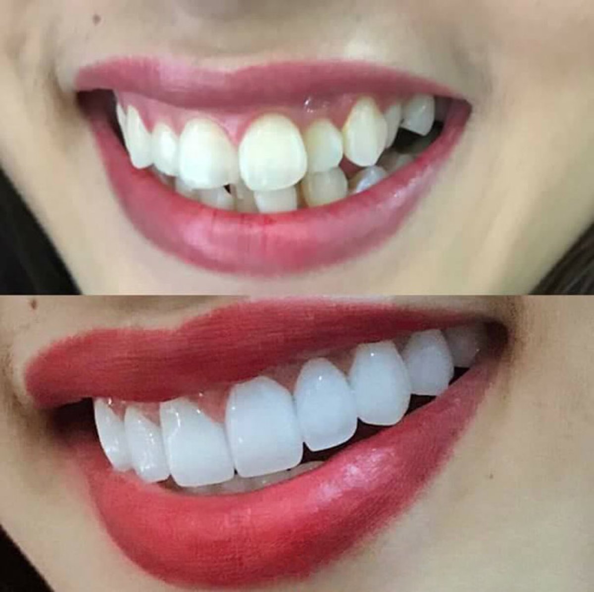 Before and after tooth whitening results at Dr. Smile Dental Clinic, brighter smile transformation