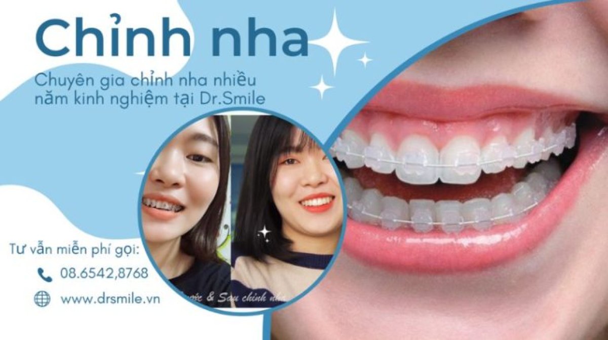 Результаты до и после элайнеров в Dr. Smile Dental Clinic, видимое выравнивание зубов