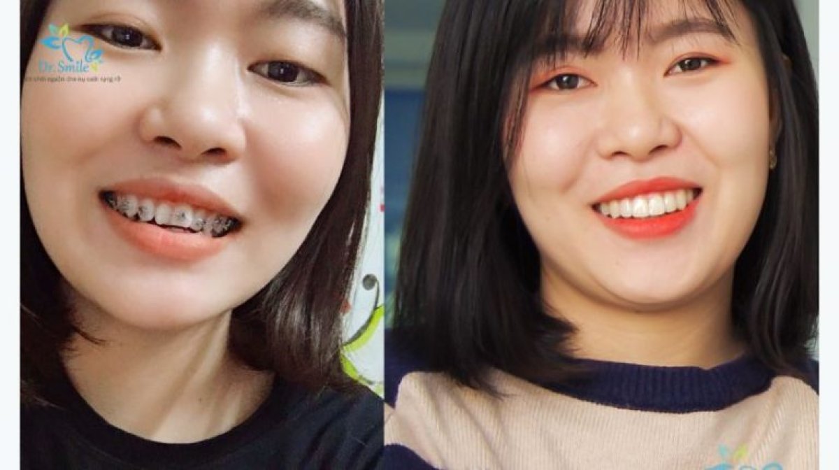 Before and after braces results at Dr. Smile Dental Clinic – improved teeth alignment and smile