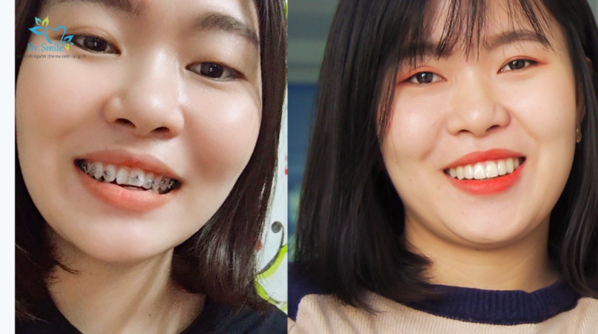 Before and after braces results at Dr. Smile Dental Clinic – improved teeth alignment and smile