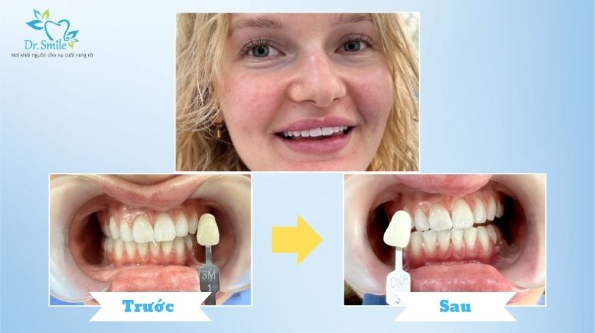 Resultados antes y después de limpieza dental (scaling) en Dr. Smile Dental Clinic, sonrisa más blanca