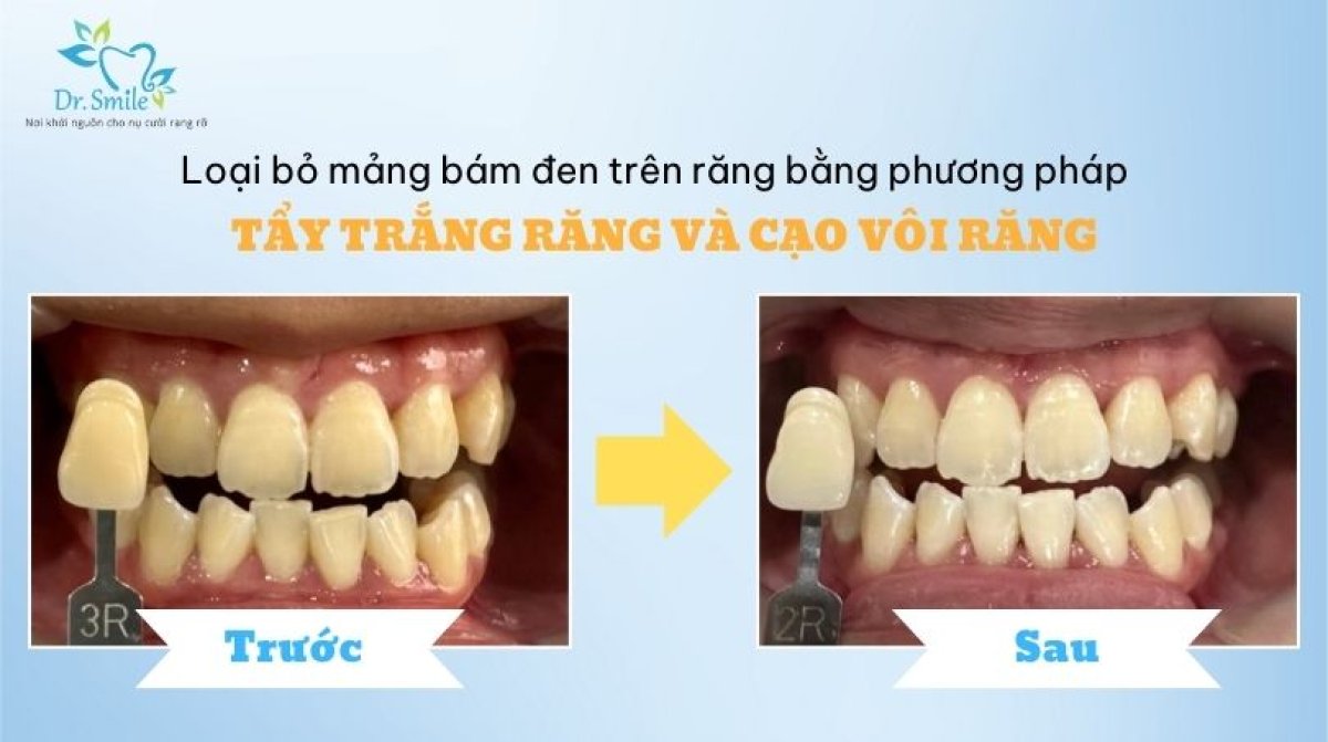 Resultados antes y después de limpieza dental (scaling) en Dr. Smile Dental Clinic, dientes más blancos