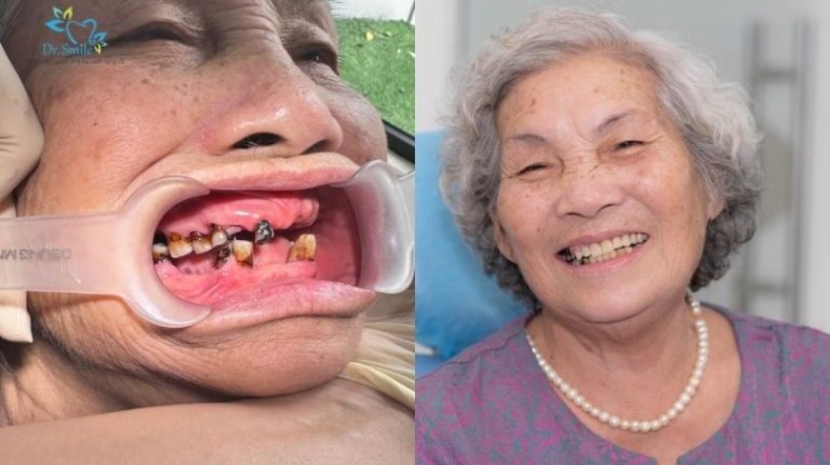 Before and after denture results at Dr. Smile Dental Clinic, restored smile for elderly patient