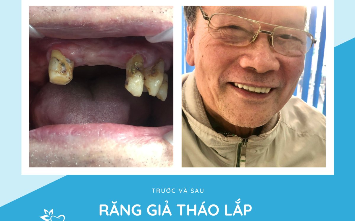 Before and after denture results at Dr. Smile Dental Clinic – improved smile restoration