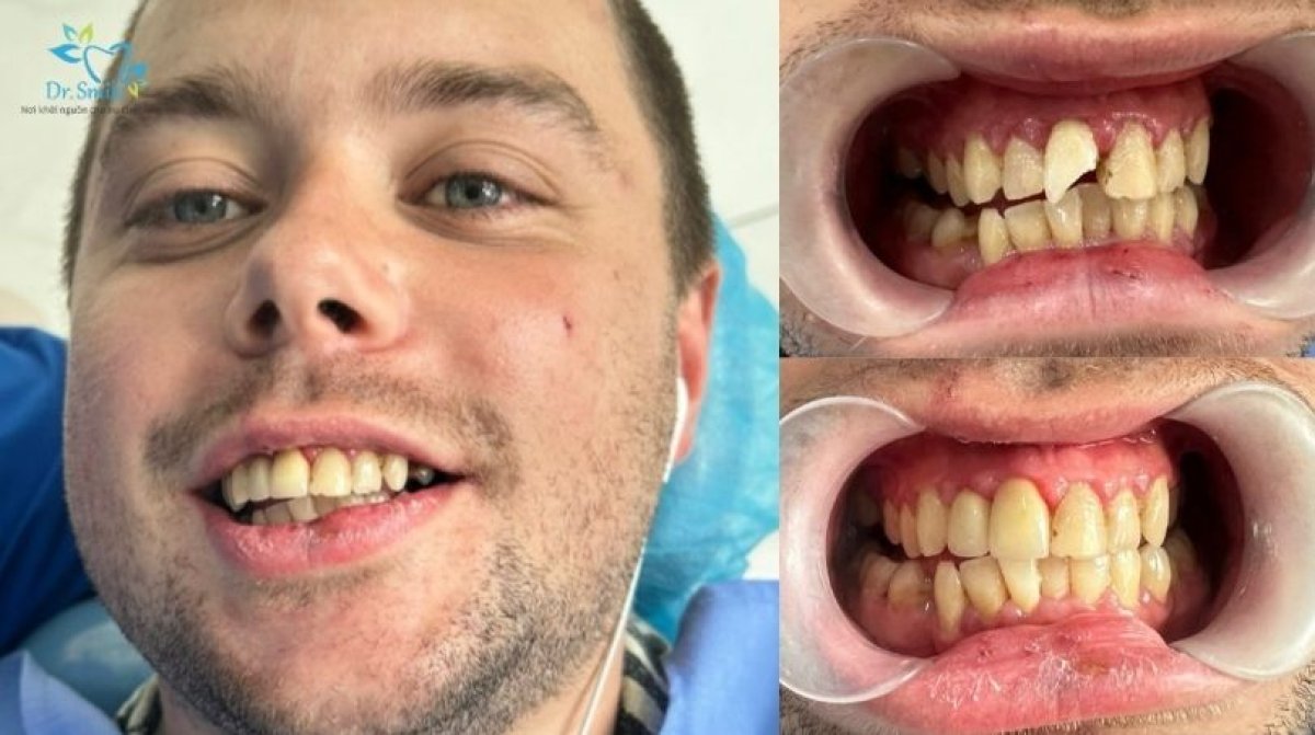 Efekty przed i po odbudowie ukruszonych zębów w Dr. Smile Dental Clinic