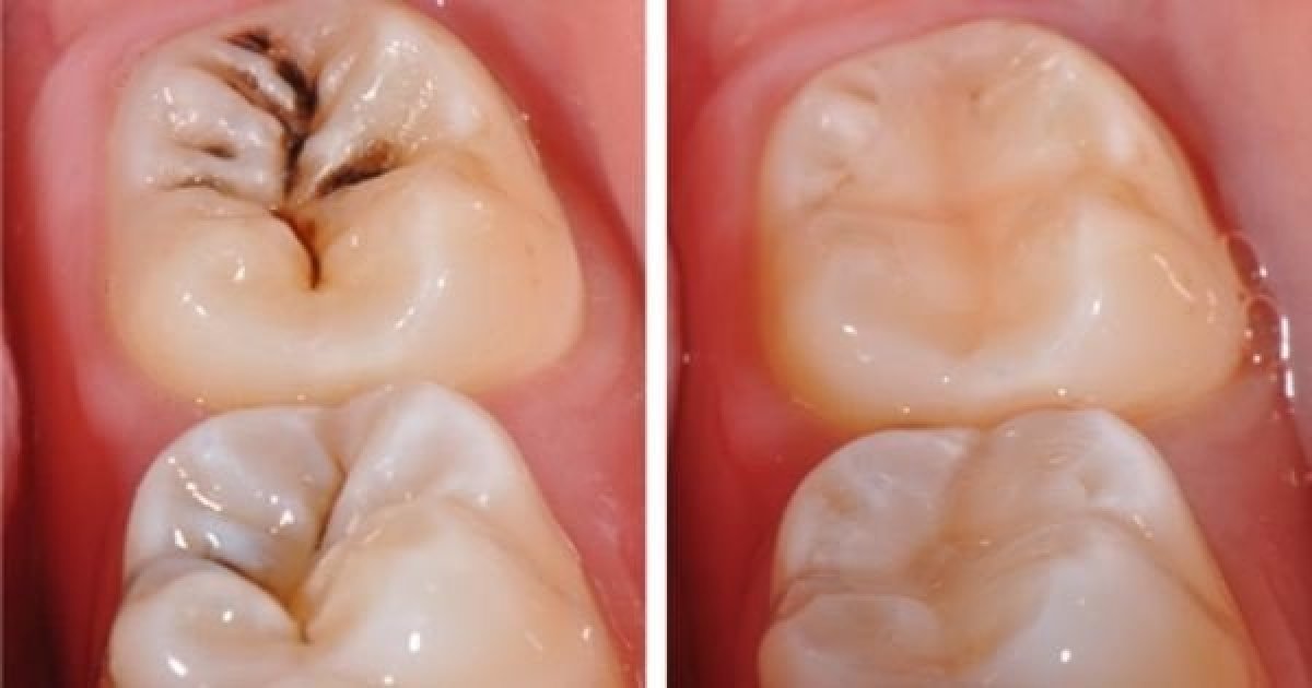 Результаты до и после композитной пломбы в Dr. Smile Dental Clinic для восстановления зуба