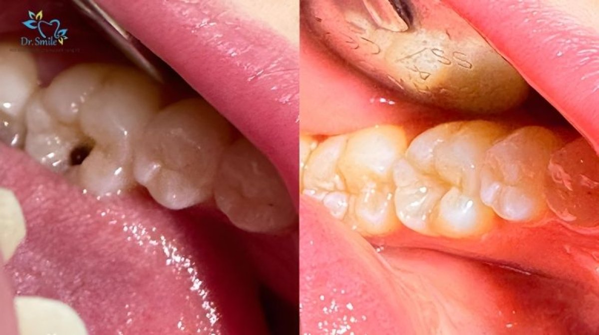 Результат до и после композитной пломбы в Dr. Smile Dental Clinic для лечения кариеса