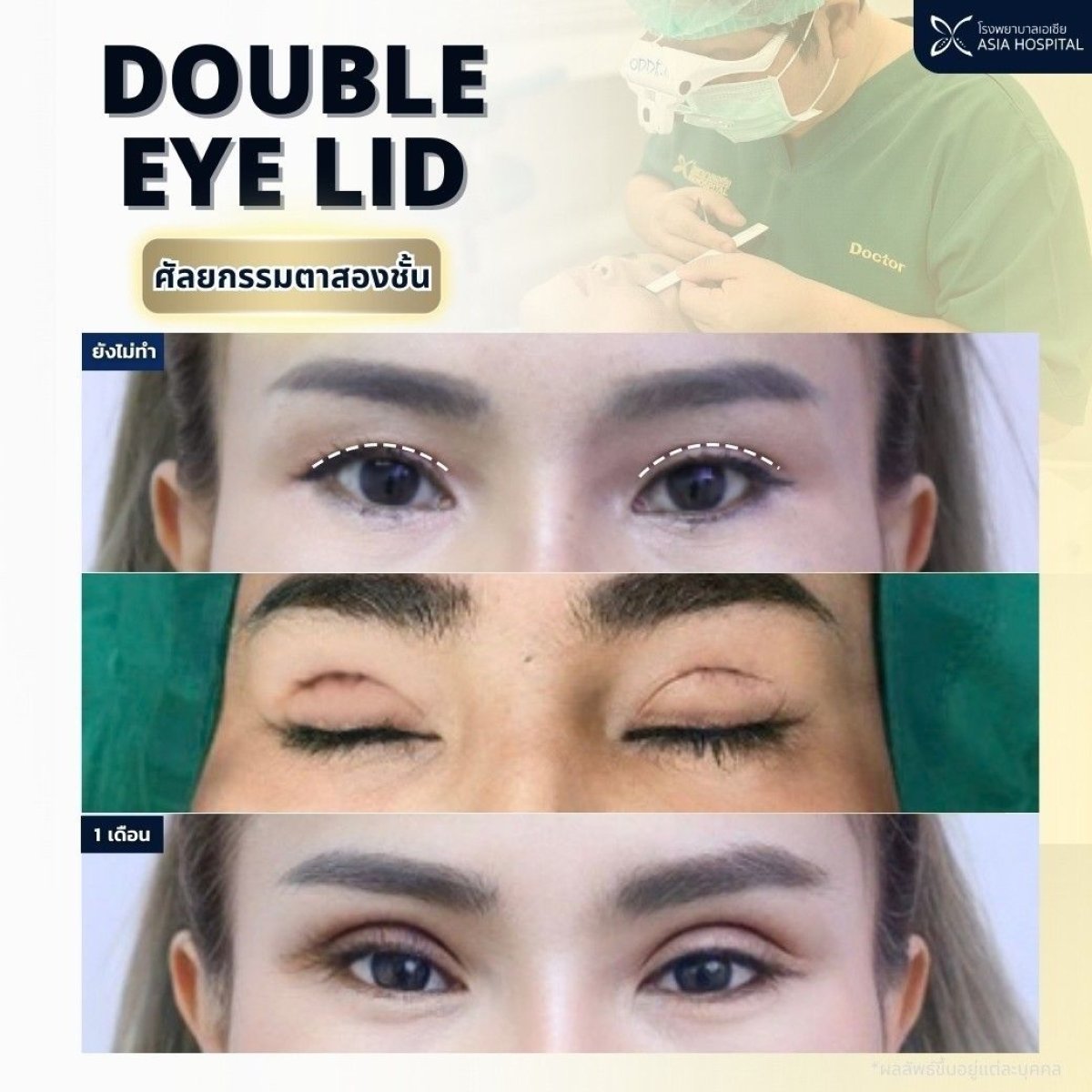 نتائج جراحة الجفن المزدوج في Asia Cosmetic Hospital، تحسين طبيعي لمظهر العين
