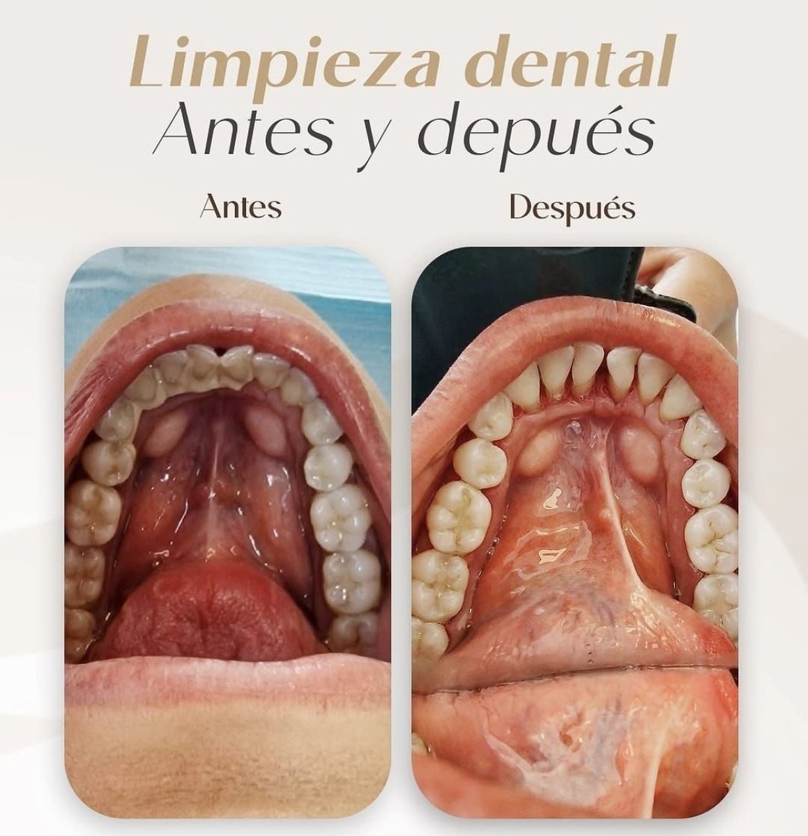 Resultados antes y después de limpieza dental en Punta cana dentist odontologia familiar, dientes limpios