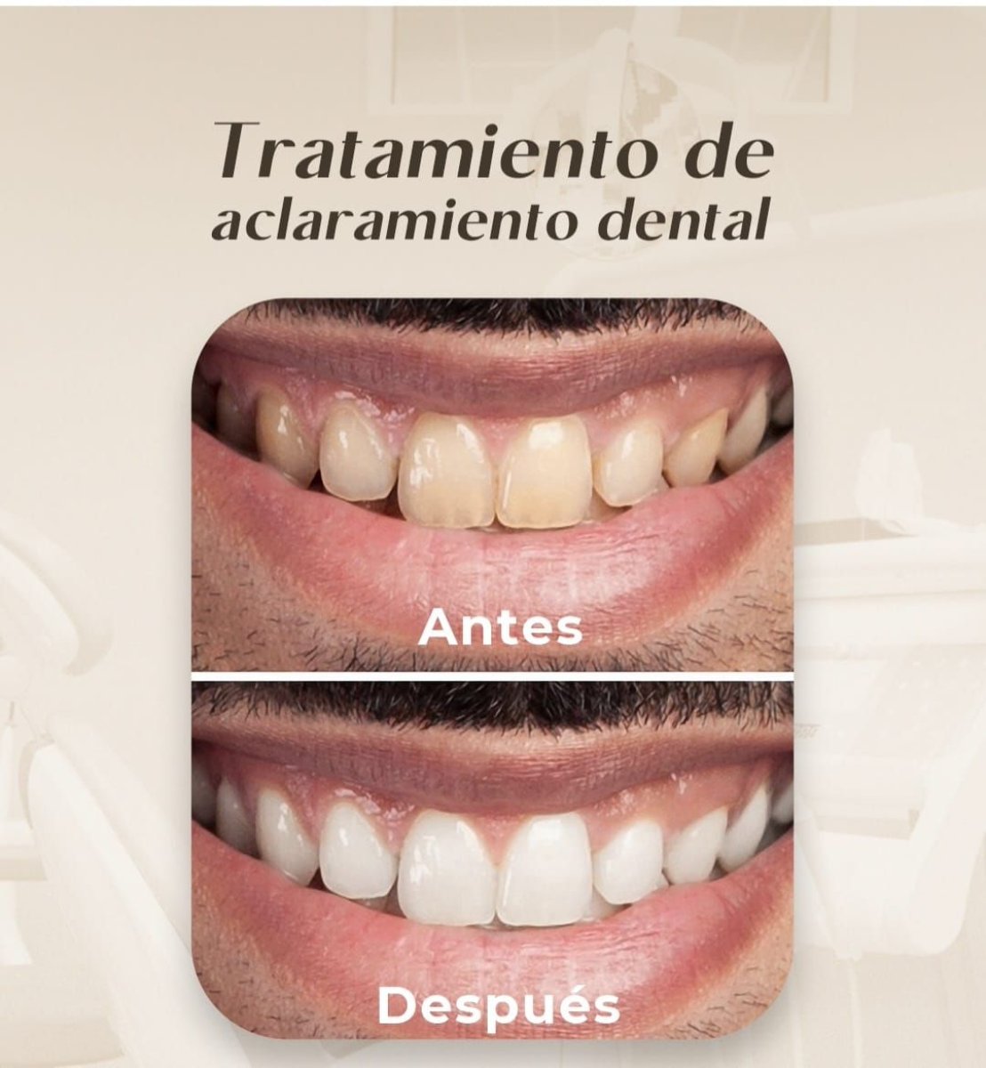 نتائج تبييض الأسنان قبل وبعد في عيادة Punta cana dentist odontologia familiar