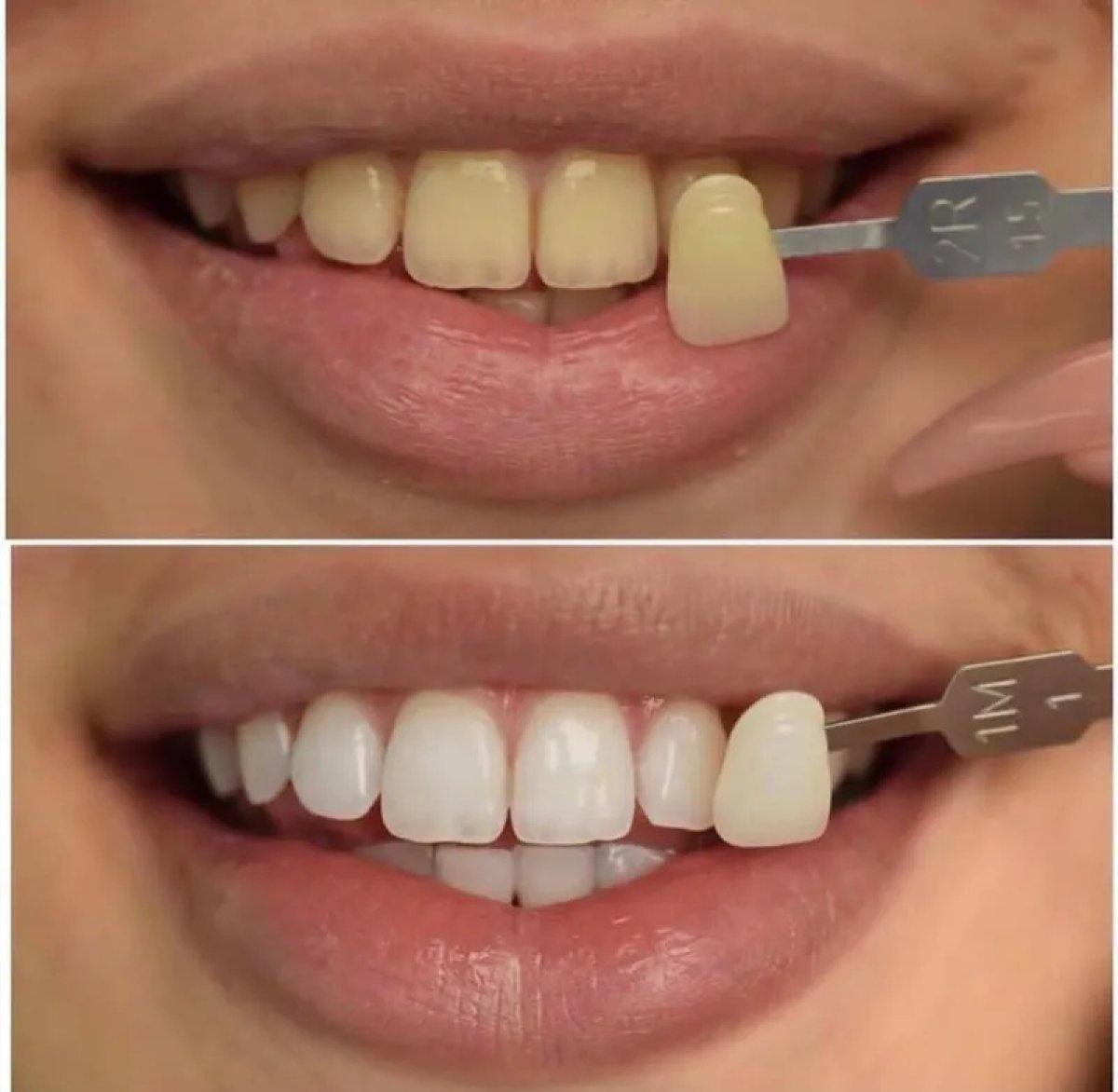 Vorher-nachher-Veneers bei 360 Dental Clinic, strahlend weißes Lächeln als Ergebnis