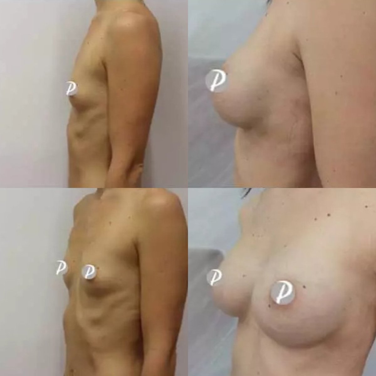 نتائج تكبير الثدي قبل وبعد في Premier Clinic، زيادة حجم الثدي