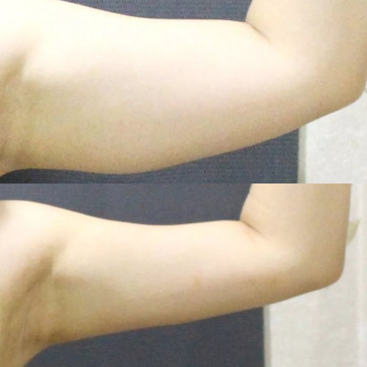 Resultados antes y después de lifting de brazos (braquioplastia) en Premier Clinic