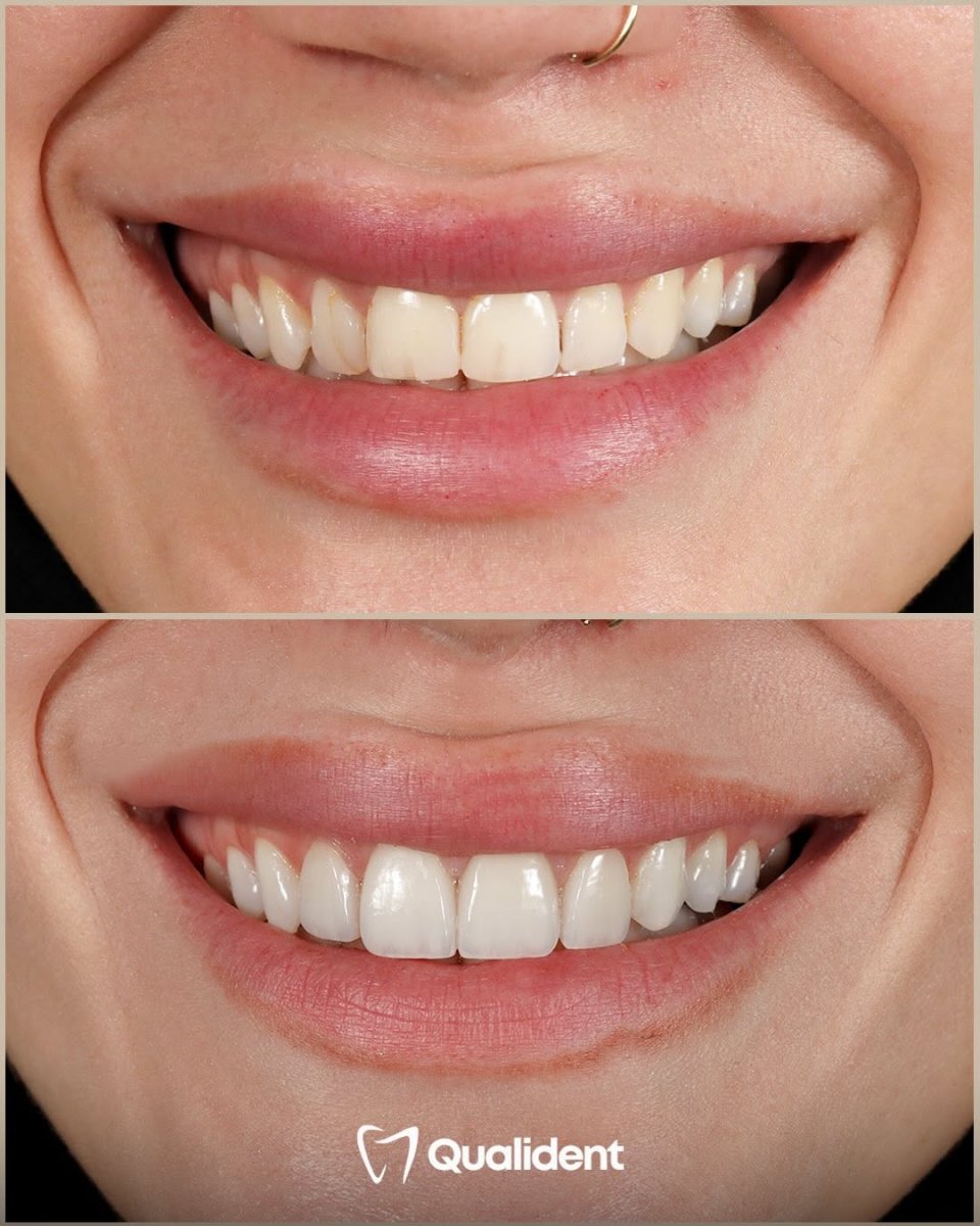 Efekt przed i po licówkach Emax w Qualident Dental Clinic – metamorfoza uśmiechu
