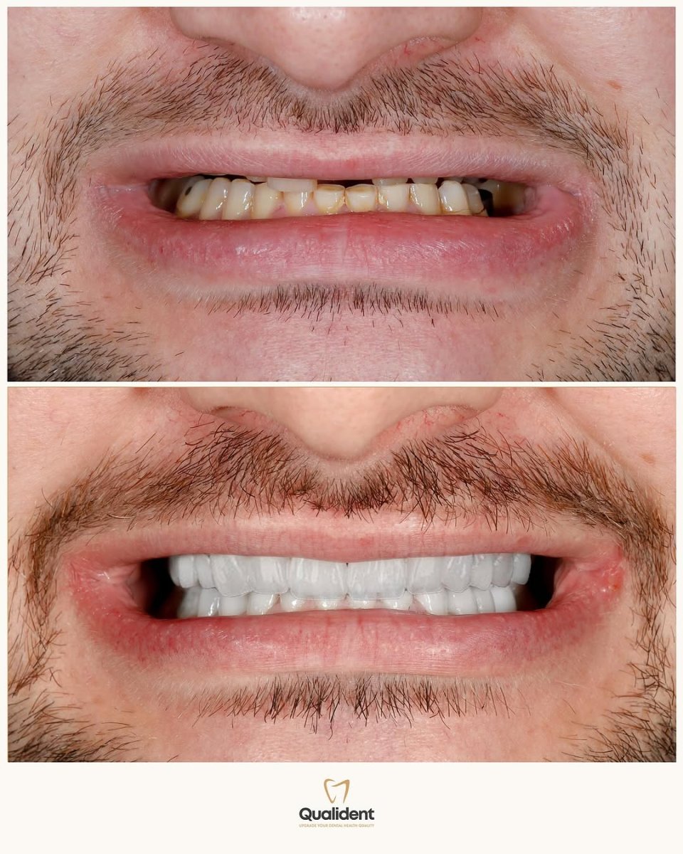 Before and after Emax veneers at Qualident Dental Clinic – smile transformation results