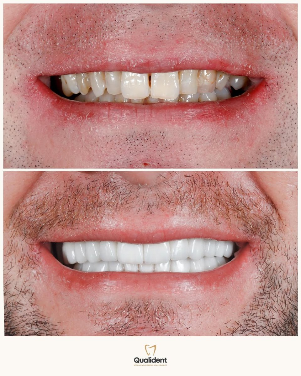 Przed i po licówkach Emax w Qualident Dental Clinic – naturalna metamorfoza uśmiechu