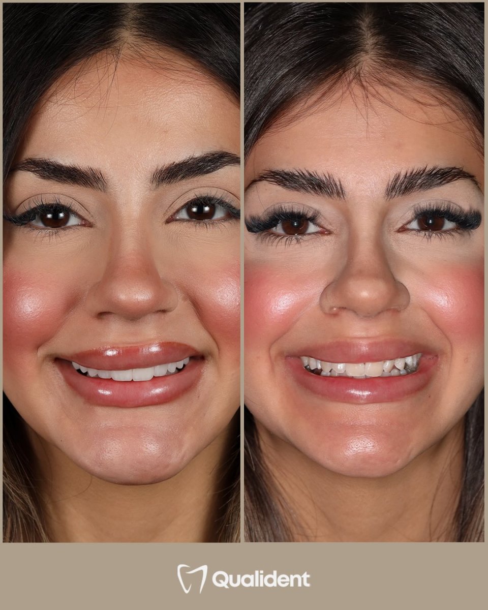 Before and after dental veneers at Qualident Dental Clinic – smile makeover result