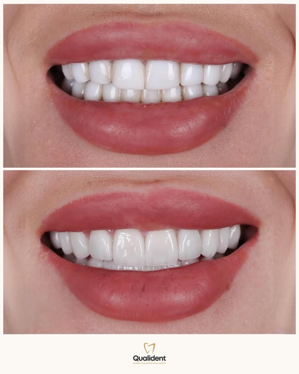 Before and after veneers at Qualident Dental Clinic – smile makeover with natural results