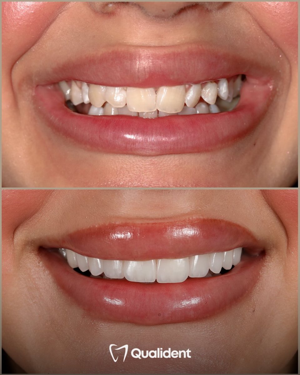 Before and after dental veneers at Qualident Dental Clinic – smile makeover results