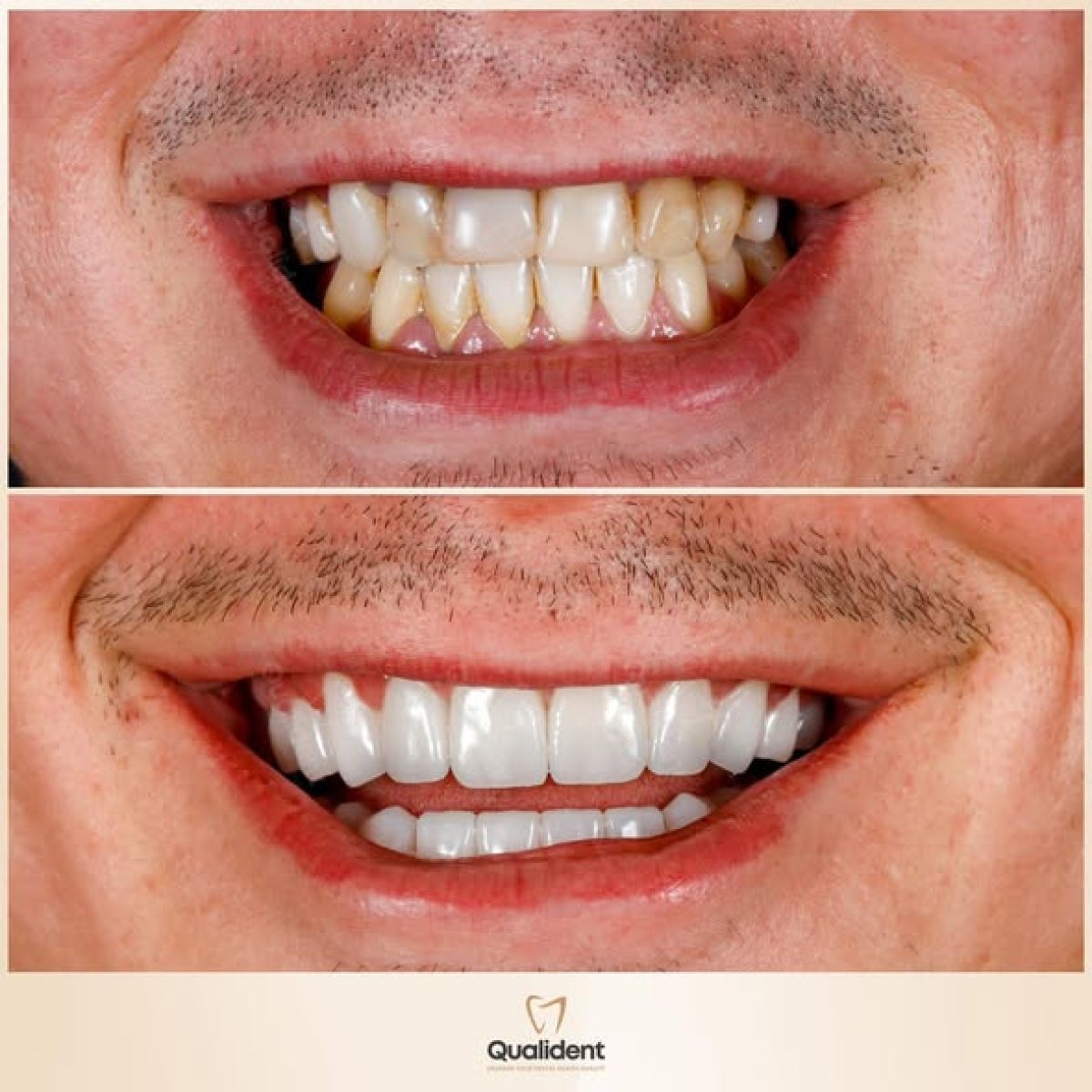 Before and after tooth whitening results at Qualident Dental Clinic – visibly brighter smile
