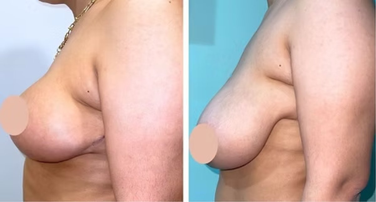 Efekty przed i po redukcji piersi w Prof. Dr. Mohamed Hazem Abdelazeem, Face & body clinic