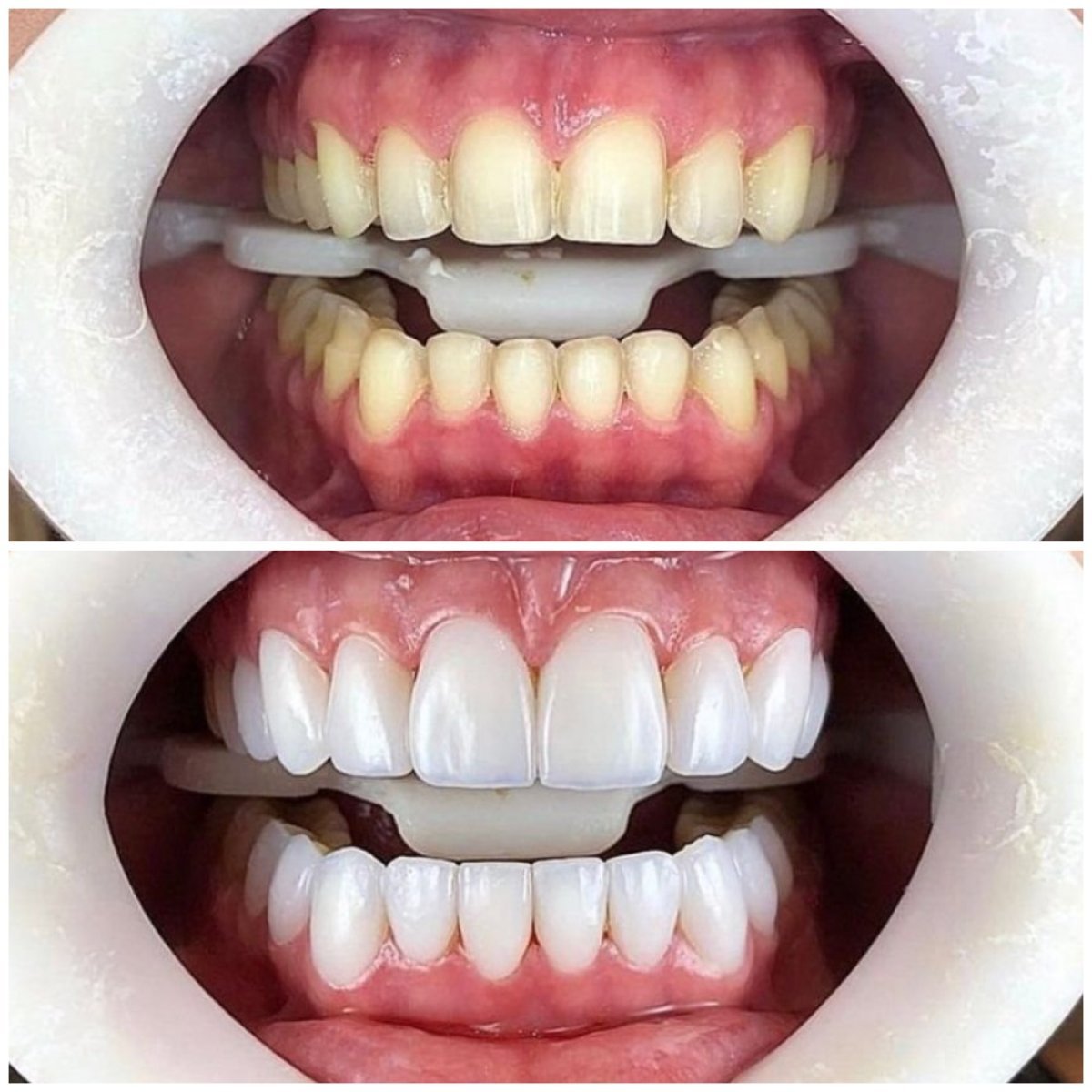 نتيجة قبل وبعد قشور إيماكس في Dental Med Austria & Elixence، تحول الابتسامة