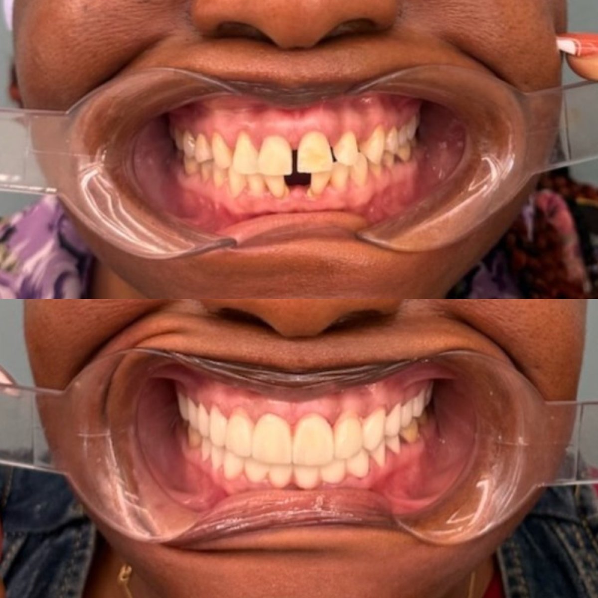 Résultats avant/après implant dentaire chez KLİNİKEN – sourire restauré, dents alignées