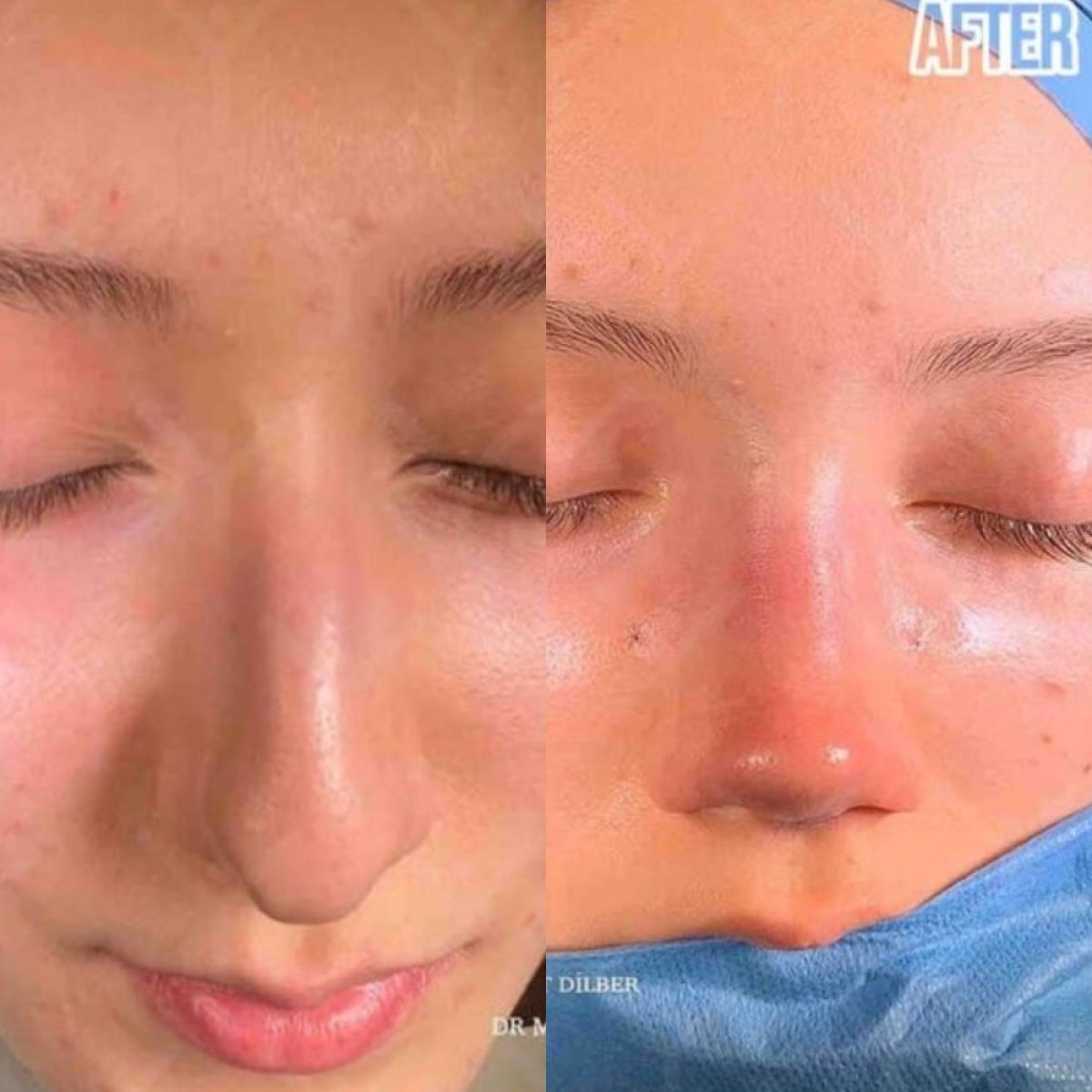 Resultados de rinoplastia antes y después en HayatMed Clinic, remodelación nasal