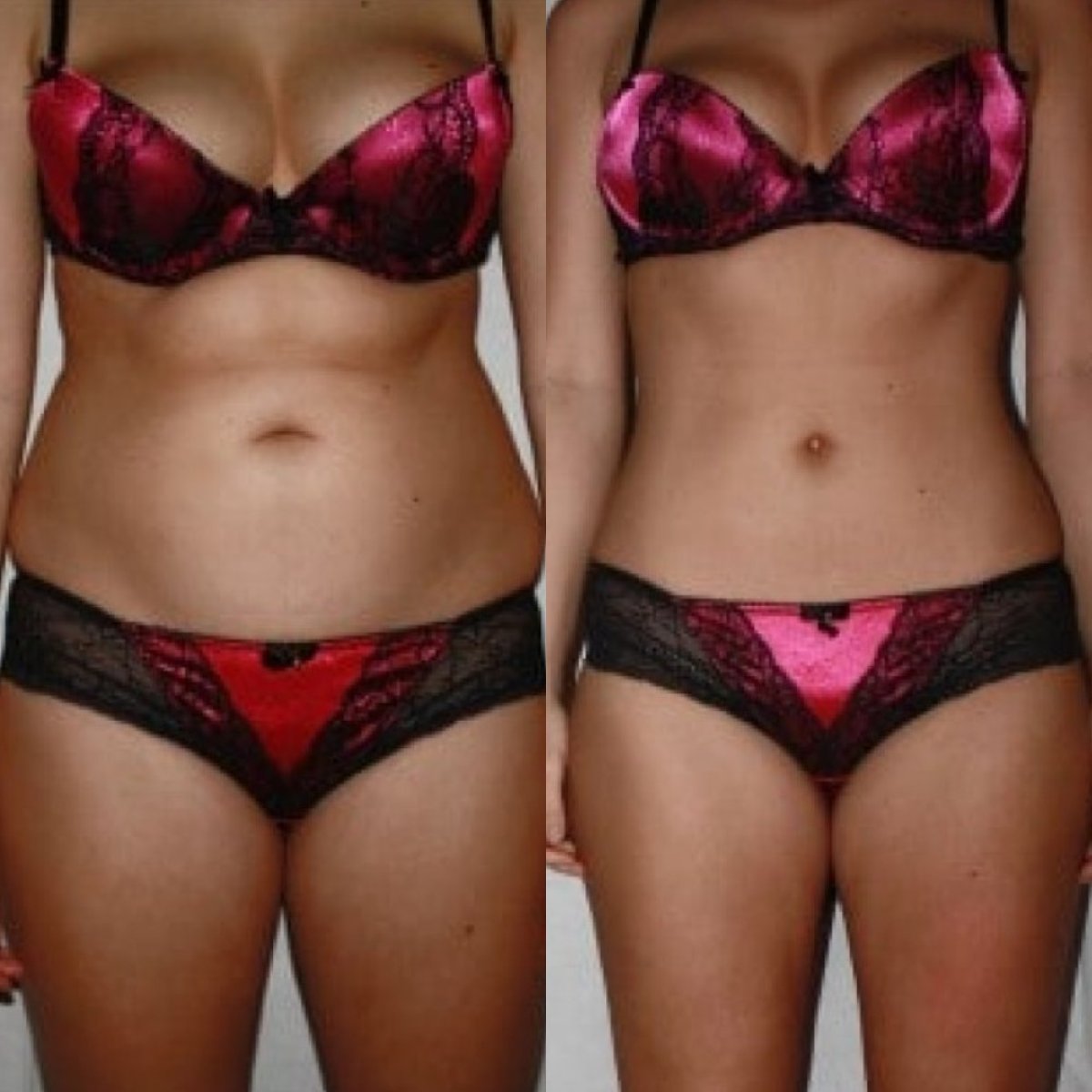 Before and after tummy tuck results at HayatMed Clinic – visible abdominal contour improvement