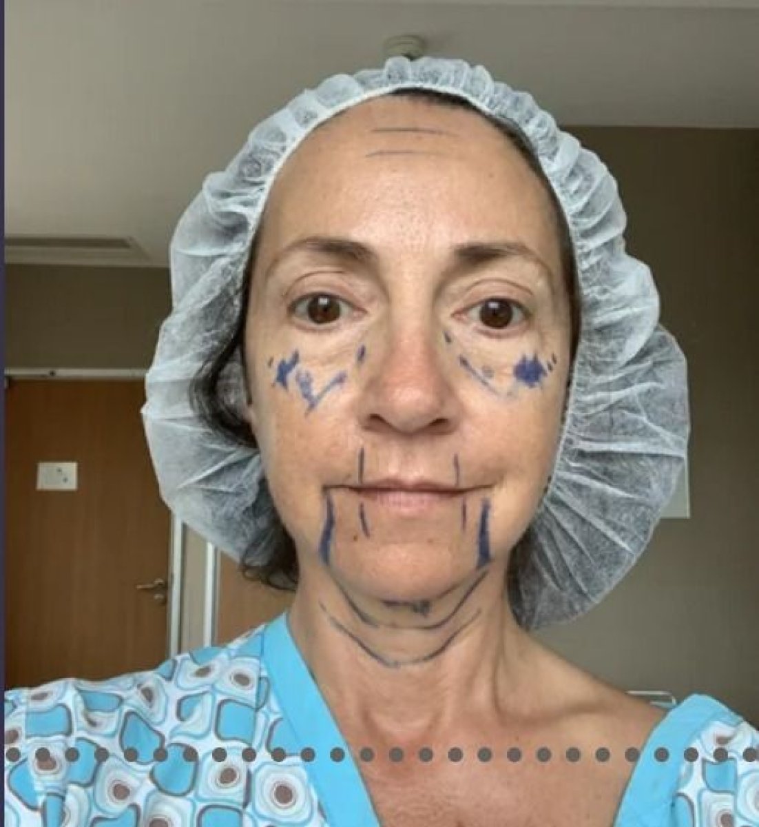 Preoperative markings for blepharoplasty at Memorial Şişli Hospital, eyelid correction prep