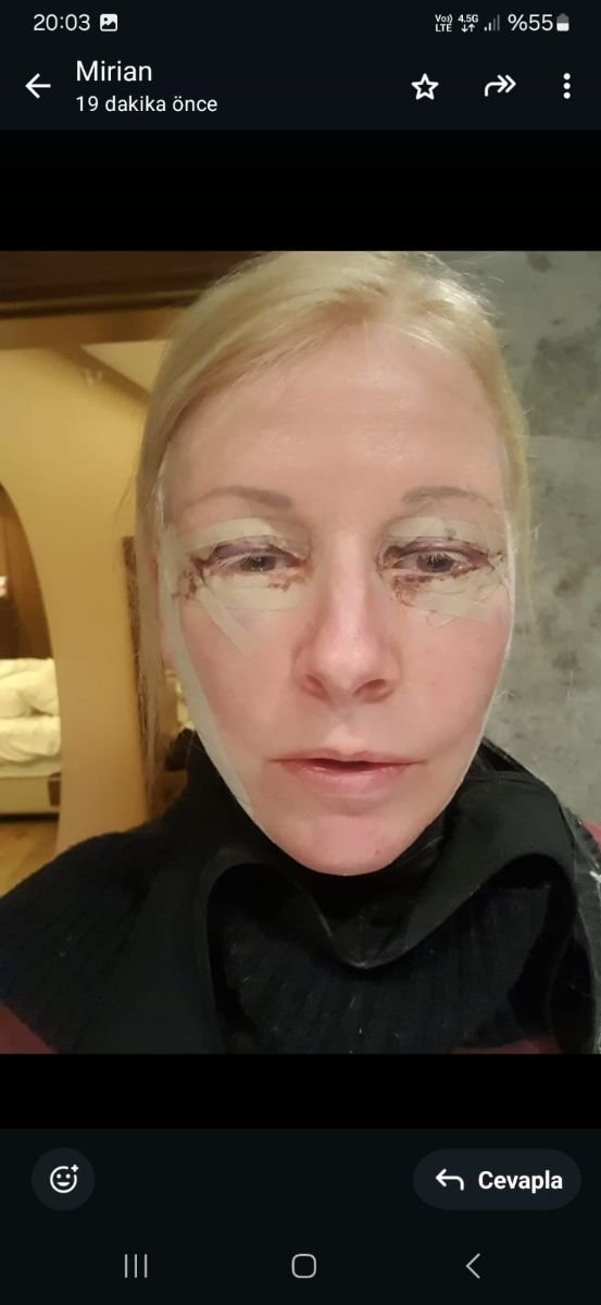 Early recovery after blepharoplasty at Memorial Şişli Hospital, eyelid surgery result