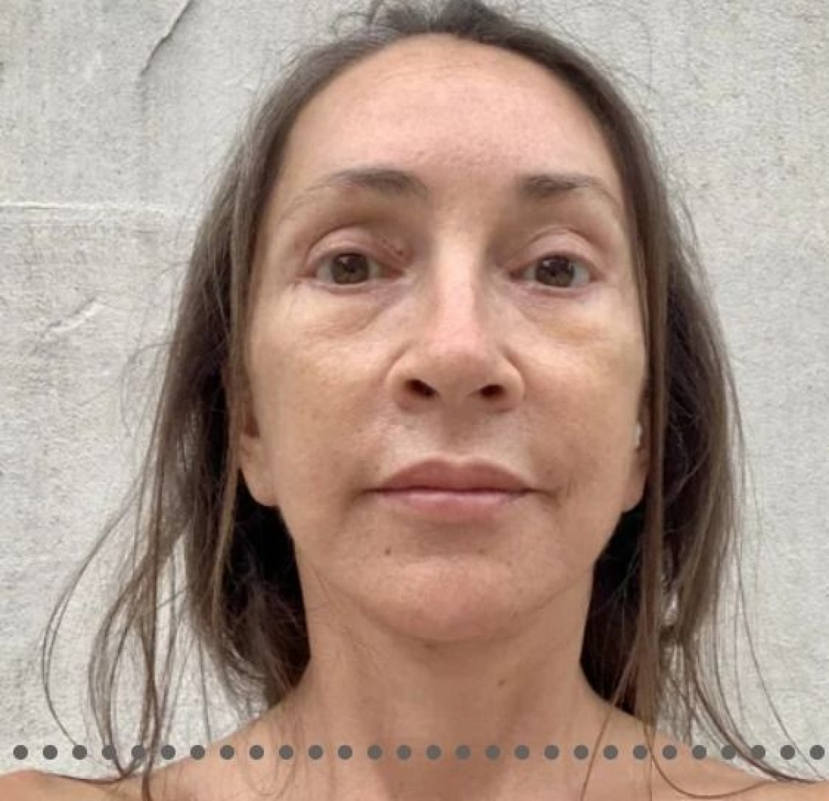 Blepharoplasty result at Memorial Şişli Hospital, visible eyelid correction and rejuvenation