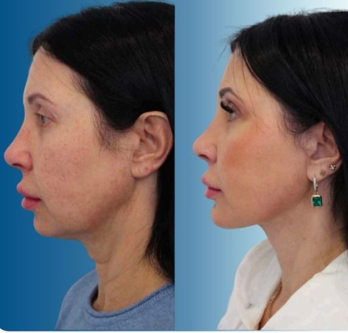 Before and after facelift results at Memorial Şişli Hospital, visible facial rejuvenation