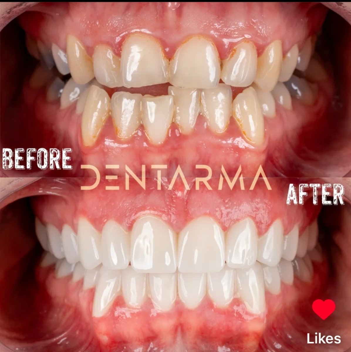 Smile makeover before and after results at Dentarma Turkey Dental Clinic, improved teeth alignment