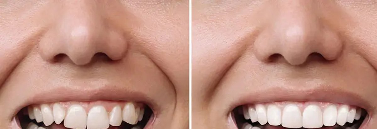 Before and after clear aligners results at Clínica Ciutat Vella – straighter teeth transformation