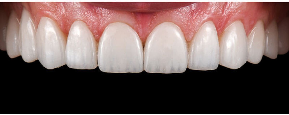 Laser teeth whitening result at Clínica Ciutat Vella – visibly brighter and whiter smile