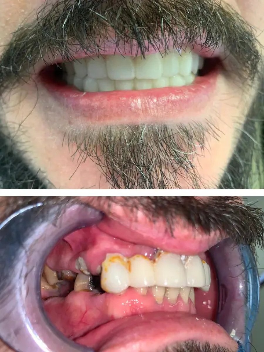 Before and after dental implant results at Clínica Ciutat Vella, restored smile transformation