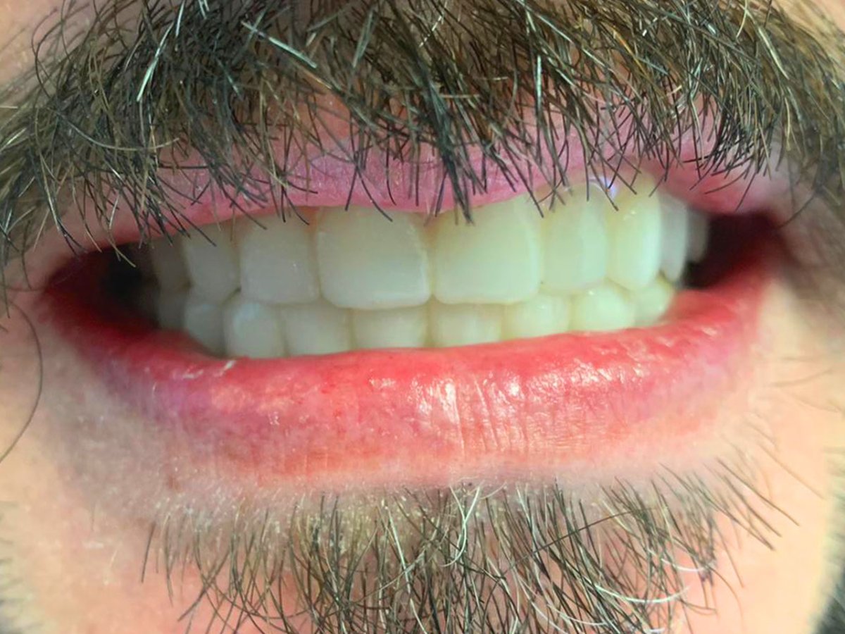 Dental implant with crown result at Clínica Ciutat Vella, restored natural-looking smile