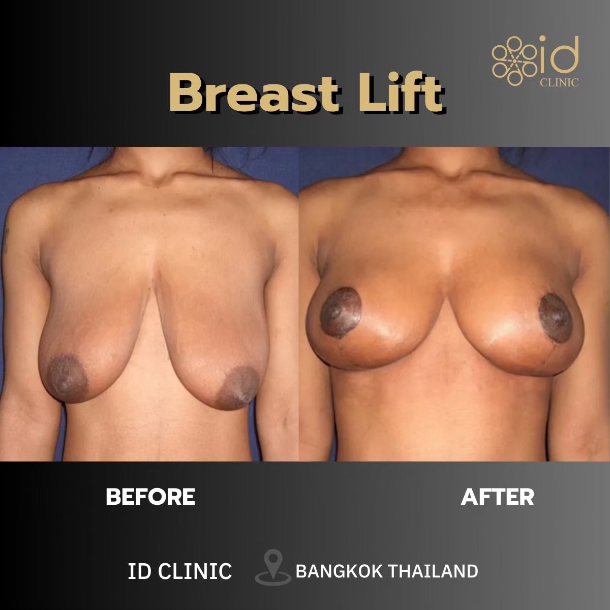 Результати до і після підтяжки грудей в ID Clinic Bangkok, покращена форма та пружність
