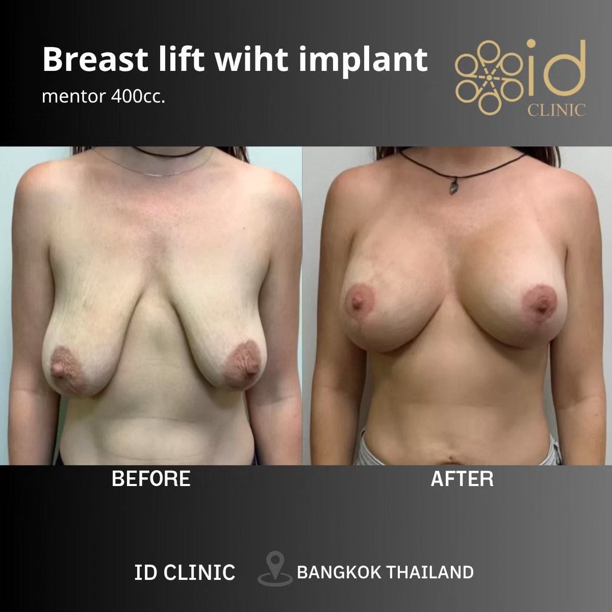 Результат до та після підтяжки грудей з імплантами в ID Clinic Bangkok, покращений контур