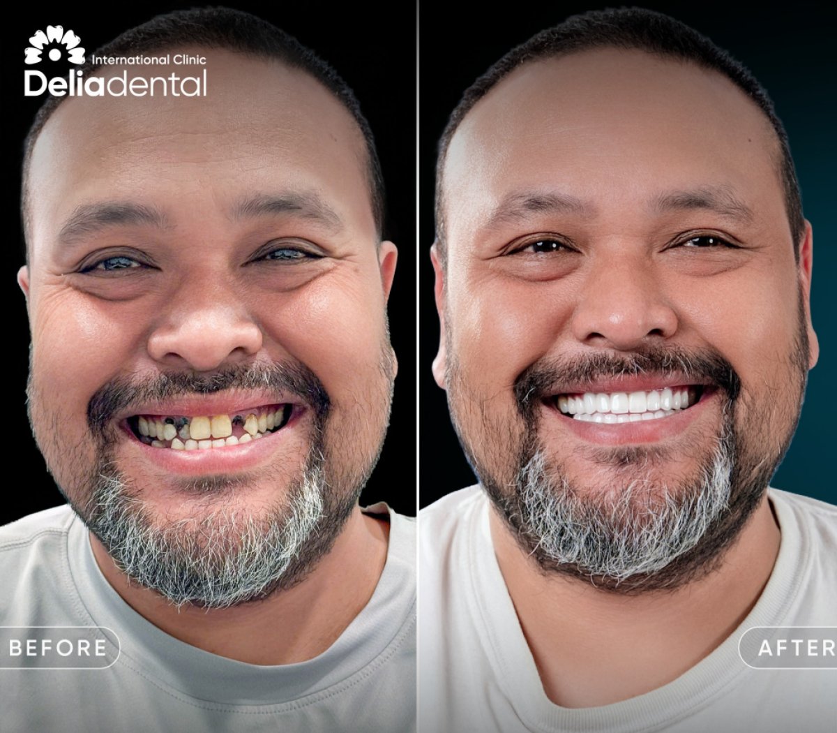 Resultado antes y después de implantes dentales All-on-6 en un día en Delia Dental