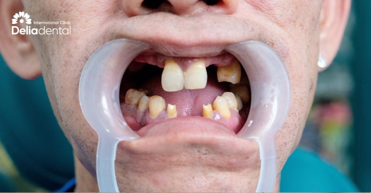 Antes de implantes All-on-6 en un día en Delia Dental: pérdida y desalineación dental severa