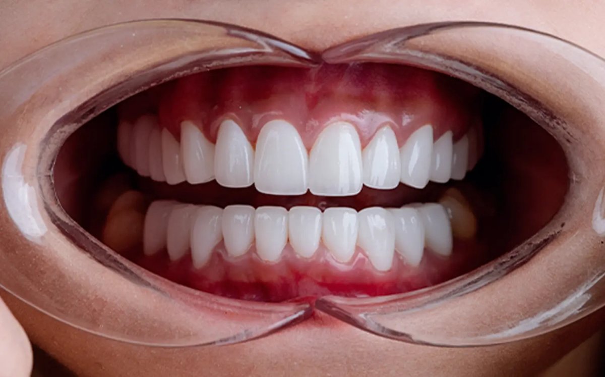 Resultado de la instalación de coronas dentales: mejora en forma y color dental