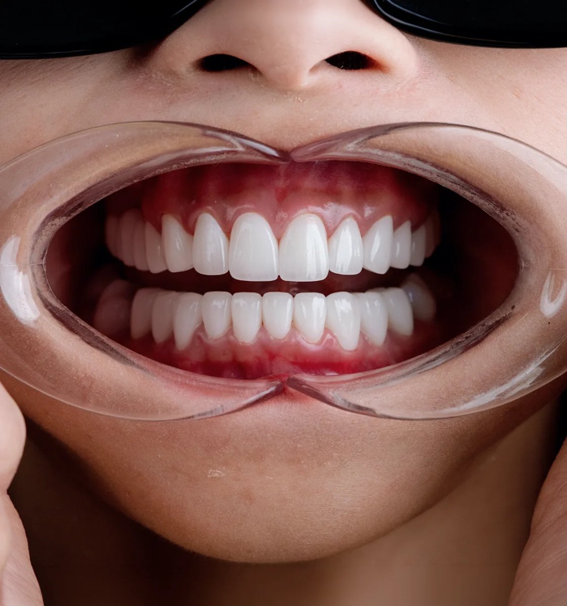 Resultado de la instalación de coronas dentales: dientes restaurados y naturales tras el procedimiento