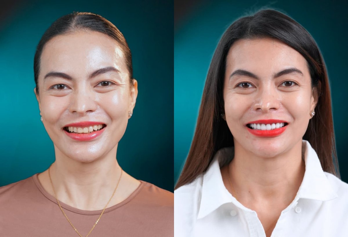 Before and after dental crown installation results – improved smile and whiter teeth
